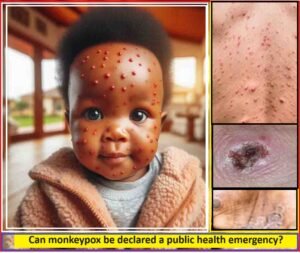 Can monkeypox be declared a public health emergency